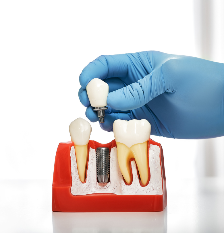 Dental Implants