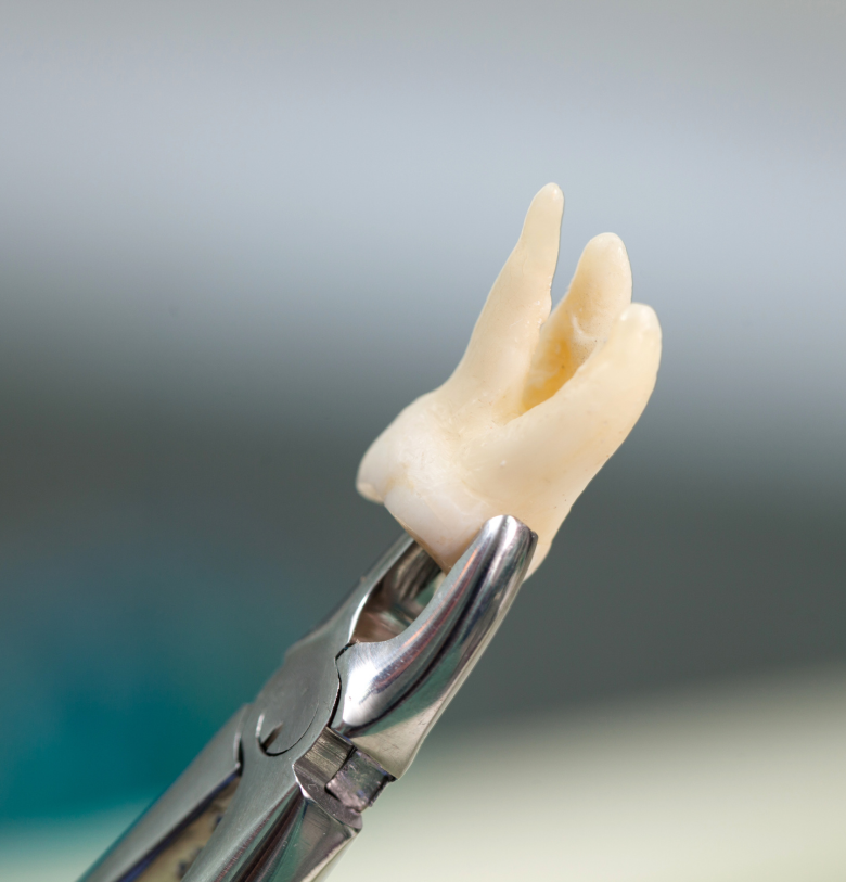 Wisdom Tooth Removal
