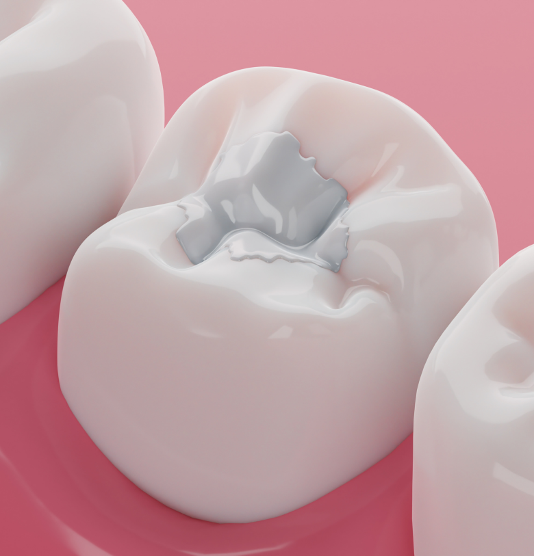 Tooth-Coloured Fillings