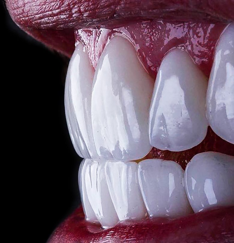 Full Mouth Rehabilitation