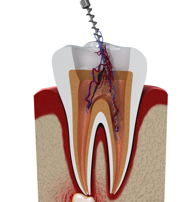 Root Canal Treatment