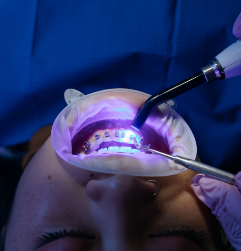 Laser Gum Therapy