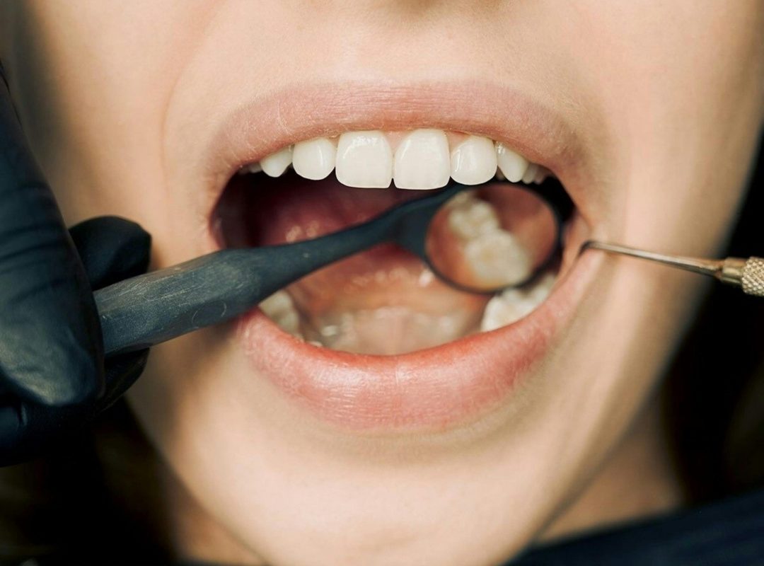 pexels-photo-12148417-12148417 Close-up of a dental examination with modern equipment, showcasing oral hygiene maintenance.