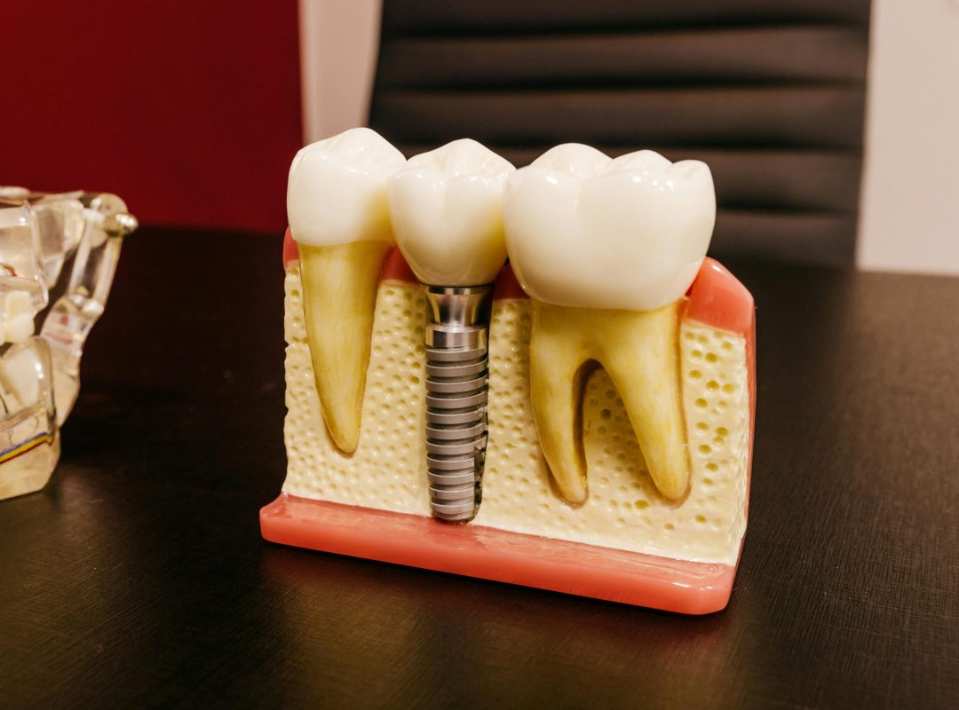pexels-photo-4687905-4687905 Close-up of a dental implant model on a professional workspace desk.