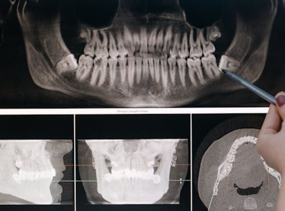 pexels-photo-6502033-6502033-1 Detailed dental X-ray showing teeth structure highlighted by a pointing pen.