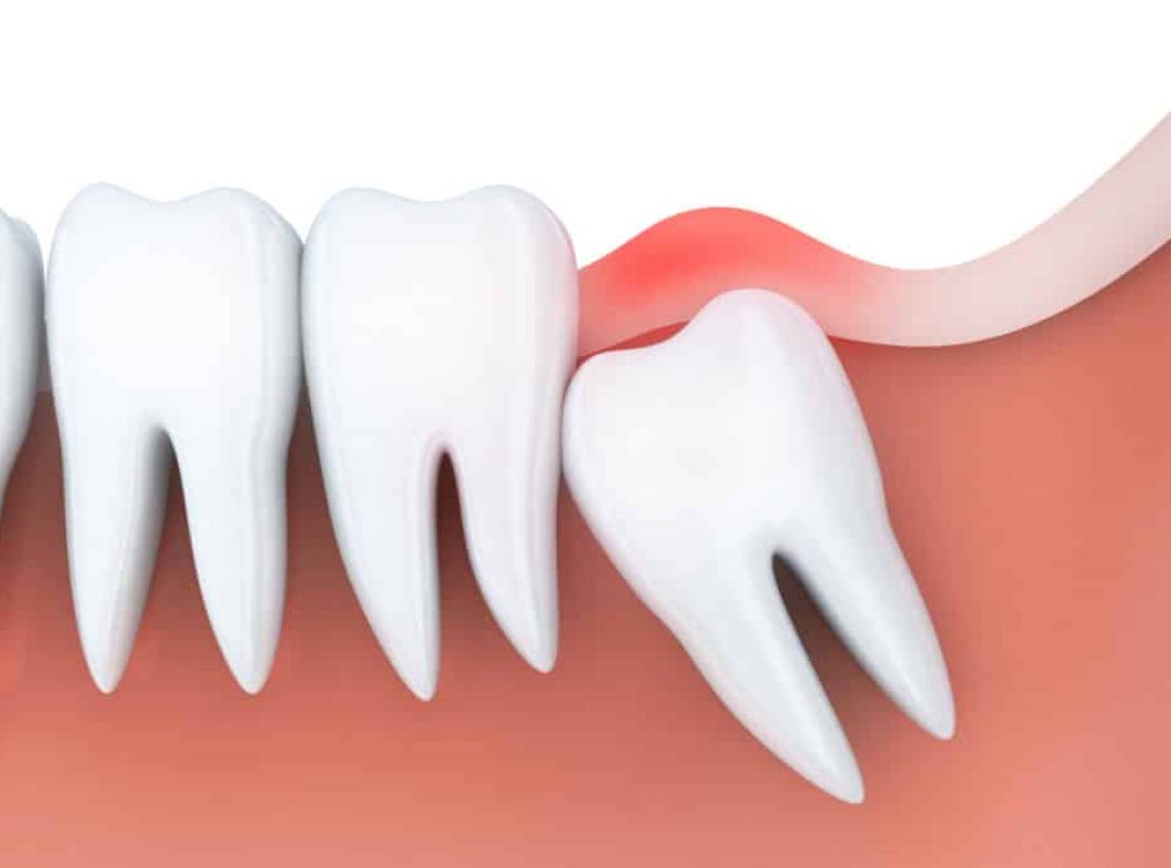 wisdom-teeth-removal-and-recovery-1024x683